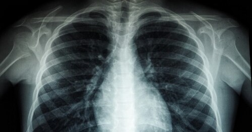 Health-Ecore joins €1.8M DELPHI project to advance personalized lung cancer treatment